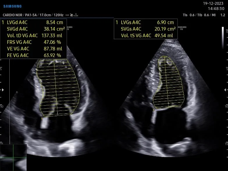 Échographe Samsung — 2D Strain ventricule droit